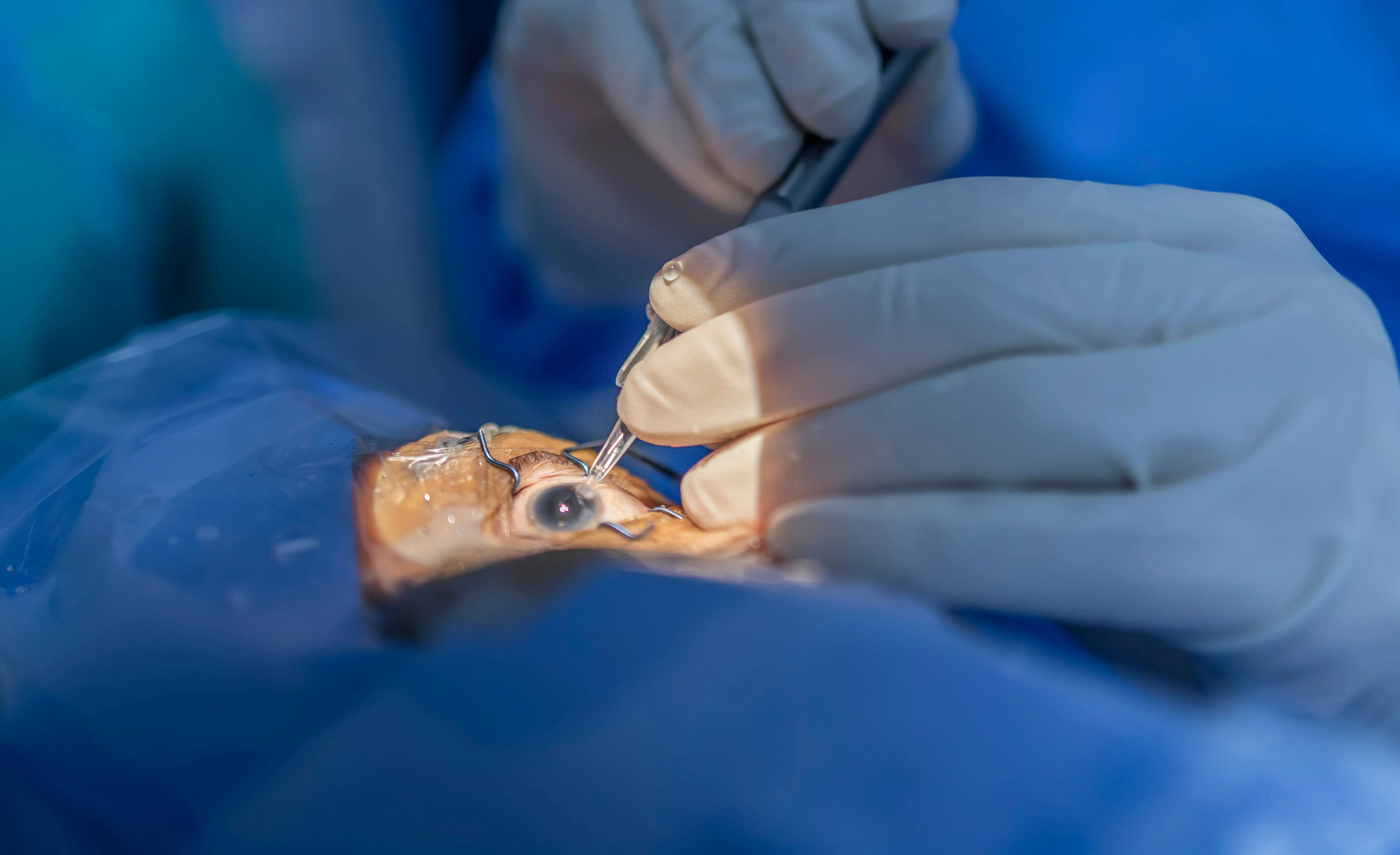 Why Did I Feel Pain During Cataract Surgery?